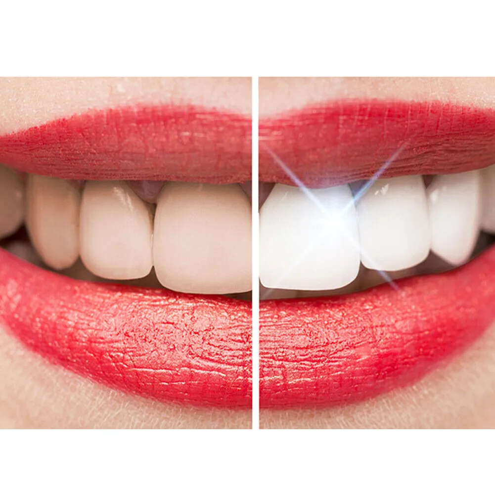 US 2-4 Pcs Intensive Stain Removal Teeth Whitening Repair Kit Smile Perfect